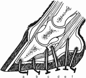 足の穿刺傷(Puncture Wounds In The Foot)