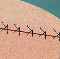 皮膚形成手術(Skin Plastic Surgery)