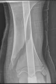 仮骨の異常・骨折の遅延治癒および偽関節