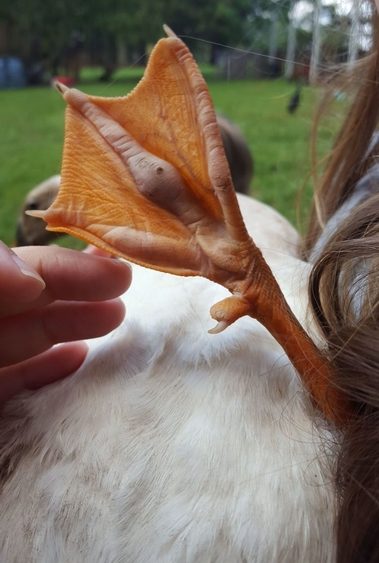 趾瘤症（しりゅうしょう） ～ 予防、早期発見、早期治療が鍵となります