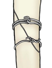 骨接合術による内固定法・髄内釘による固定