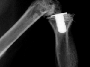 骨幹端の骨折の治療・骨端（線）の骨折分離の治療